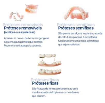 Polimetilmetacrilato: Uma Visão Geral sobre suas Propriedades e Aplicações em Próteses Dentárias!